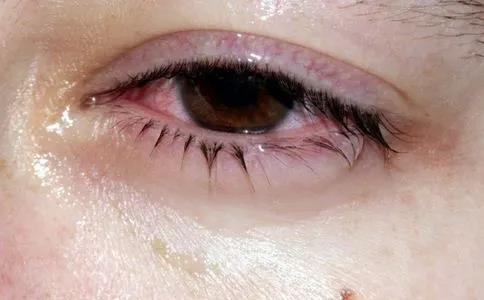 眼睛發(fā)癢難忍，竟是因?yàn)樗?></a></dt>
        <dd>
          <h2><a href=